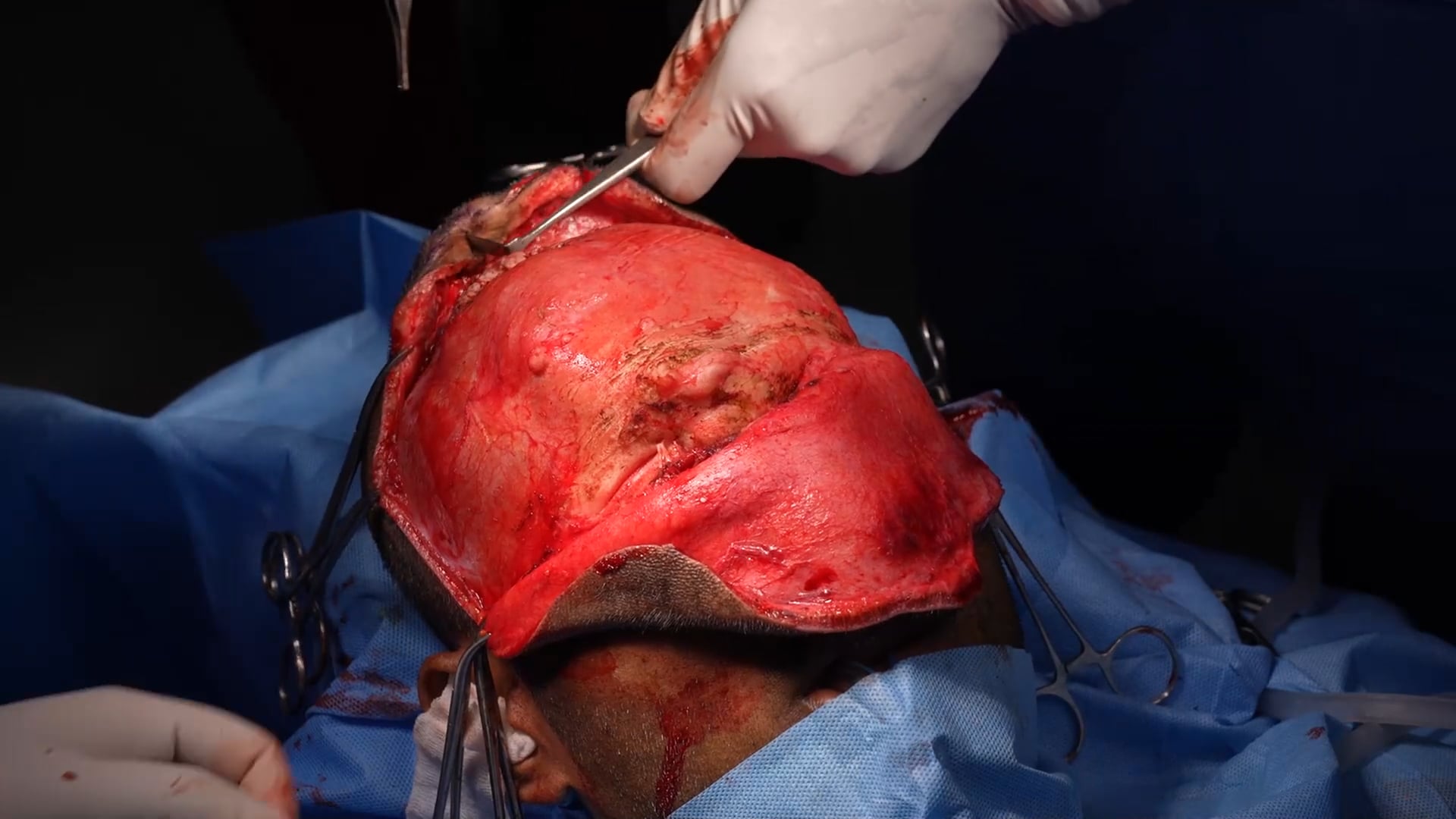 Osteoma Tumor Removal Surgery